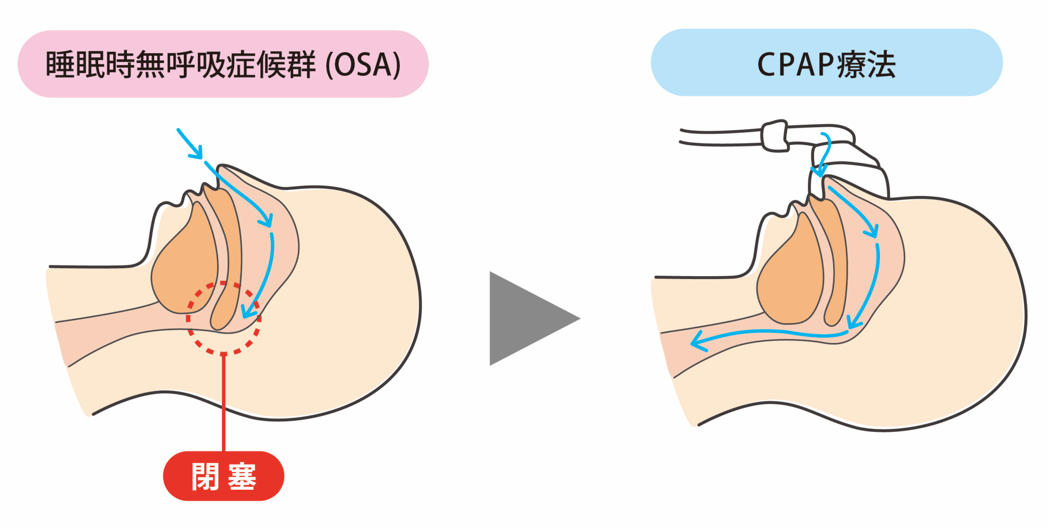 CPAP療法（持続陽圧呼吸療法）とは